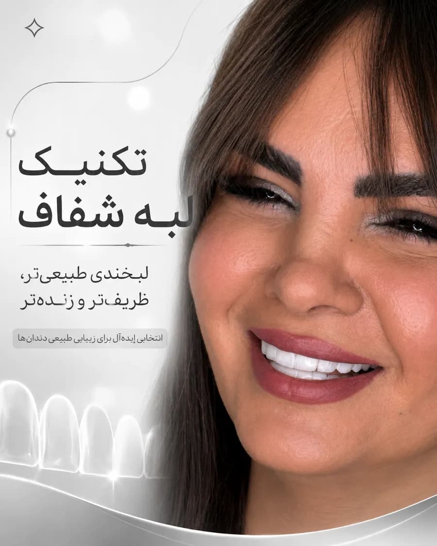 تصویر معرفی تکنیک لبه شفاف در کامپوزیت دندان